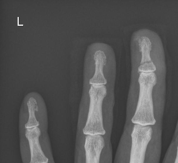 distal-phalanx-1.jpg